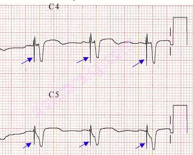 <p>One pacemaker focus.</p>