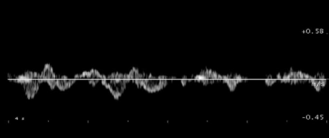 <p>Which of the following statements is true regarding the Doppler tracing displayed?</p>