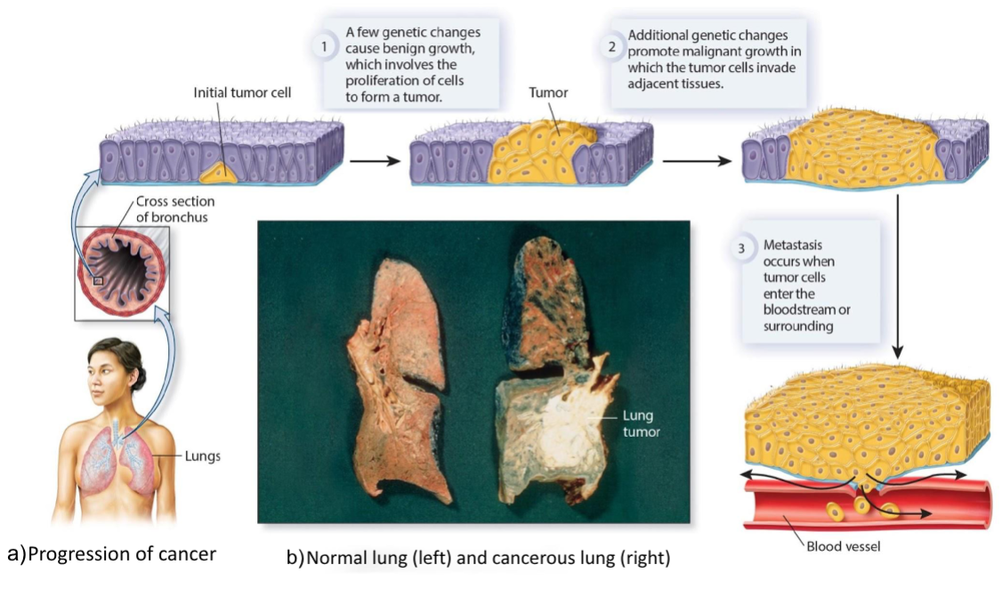 <ol><li><p>Genetic changes cause benign growth and eventually formation of tumor</p></li><li><p>Additional genetic changes promote malignant growth in which tumor cells invade adjacent tissues</p></li><li><p>Metastasis occurs when tumor cells enter the bloodstream or surrounding</p></li></ol><p></p>