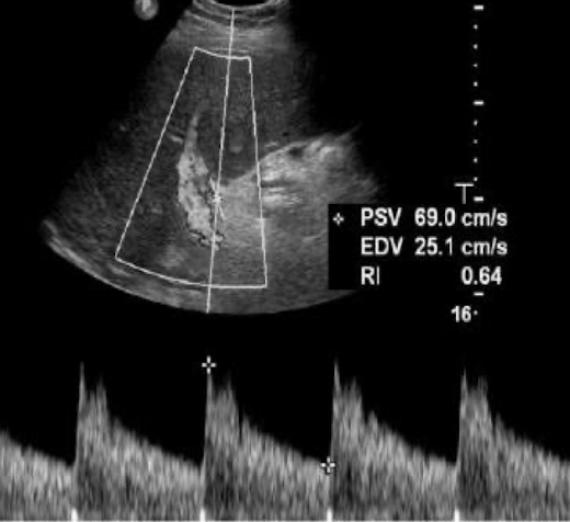 <p>is this normal or abnormal RI for transplant HA?</p>
