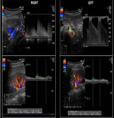 <p>images from a 15 year old with significant HTN. What is the most likely cause for the abnormality demonstrated? </p>