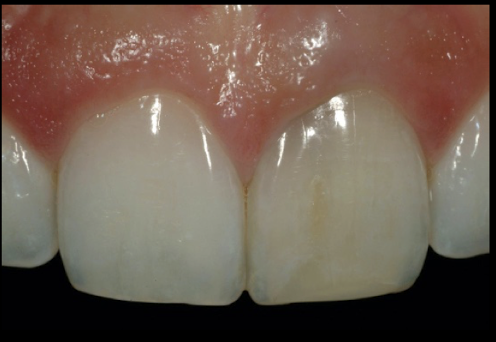 <ul><li><p>endo tx </p></li><li><p>tetracycline discoloration </p></li><li><p>to enhance existing tooth color </p></li></ul><p></p>
