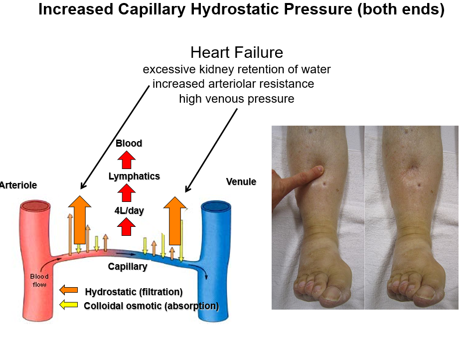 <p>Fluid leaves capillaries</p>