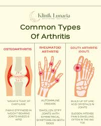 <p>inflammation/degenerative disease of the joint where synovial membranes thicken (<strong>pannus</strong>) and fluid production decreases = friction and pain</p><p><strong>arthroscopic surgery</strong> may be necessary to treat injuries + install artificial joints</p><ul><li><p><strong>osteoarthritis</strong> (AKA degenerative arthritis/joint disease): affects individuals 60+ normally. can result from wear and tear or genetic factors (collagen). 25% of women and 15% of men over age 60 show signs of this</p></li><li><p><strong>rheumatoid arthritis</strong>: an autoimmune disease. can occur at any age but more common in middle age + women. infection, genes, and hormone changes can cause this. usually impacts joints on both sides of body equally. most common parts: wrists, fingers, knees, feet, and ankles. </p></li><li><p><strong>gouty arthritis</strong>: gout is caused by too much uric acid in the blood = form hard crystals in joints. this causes burning pain, stiffness, and swelling, especially in big toe. more common in men. </p></li></ul><p></p>