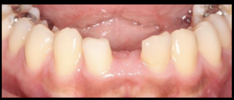 <p>if you wanted to do direct composite in this case, how would you approach </p>