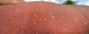 <p>erythema toxicum</p>