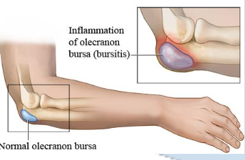 <p>Olecranon Bursitis</p>