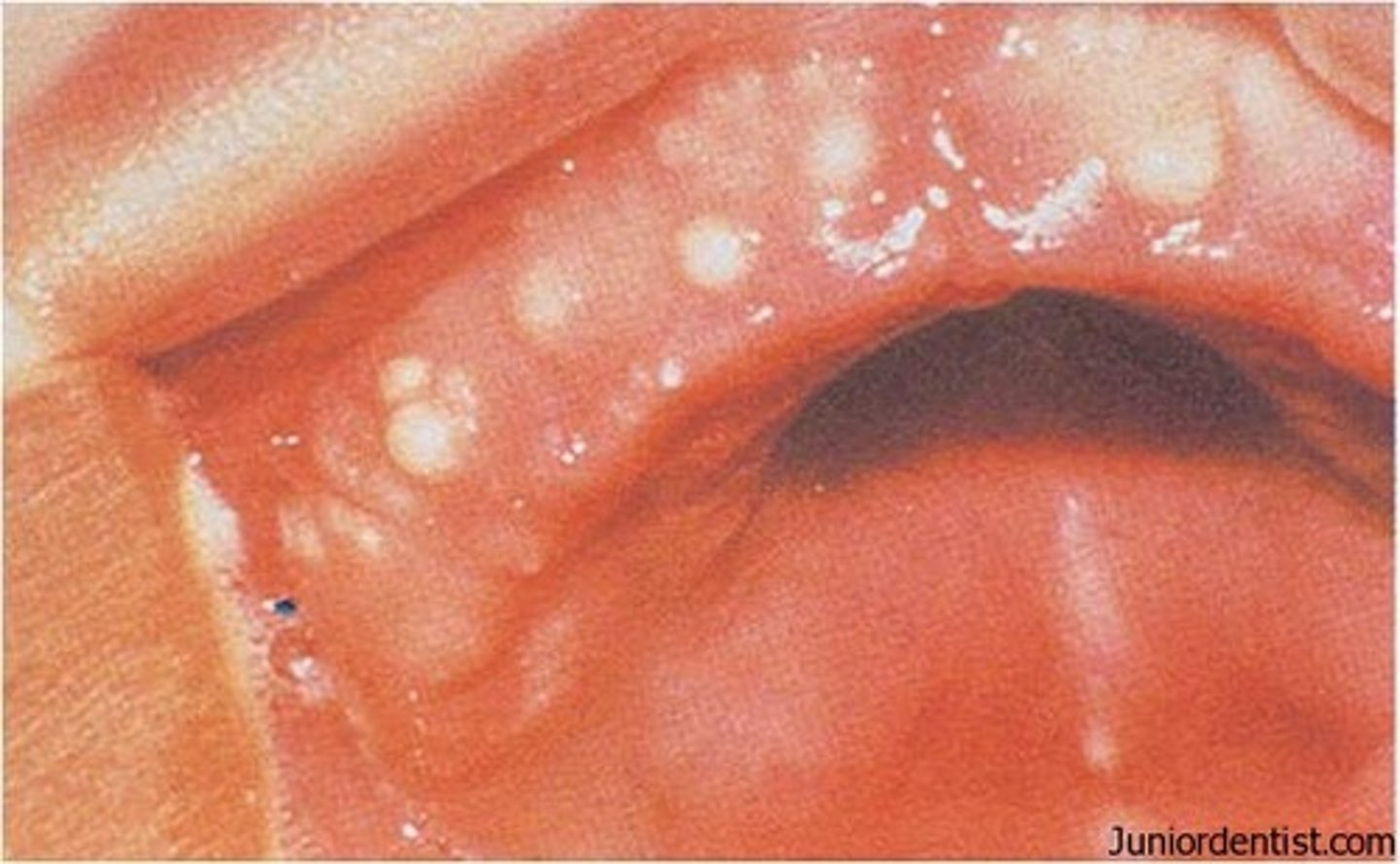 <p>benign inclusion cysts in the midline between the hard and soft palate</p>