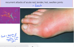 <p>Gout</p>