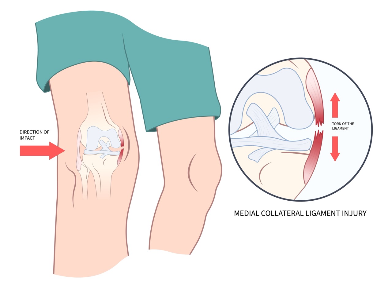 <p>Primary medial stabilizer; protected during exposure and selectively released to balance a tight medial gap.</p>
