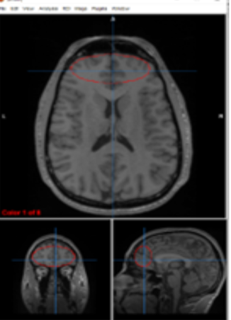 <p>prefrontal cortex</p>