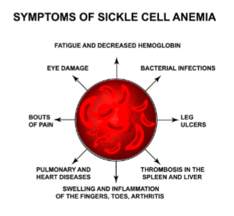 <p><span style="line-height: 20.925px;">The sickle cell phenotype is a single genetic change that causes multiple changes in systems throughout the body like skin and eye damage, blood clots, high blood pressure, heart disease&nbsp;</span></p>