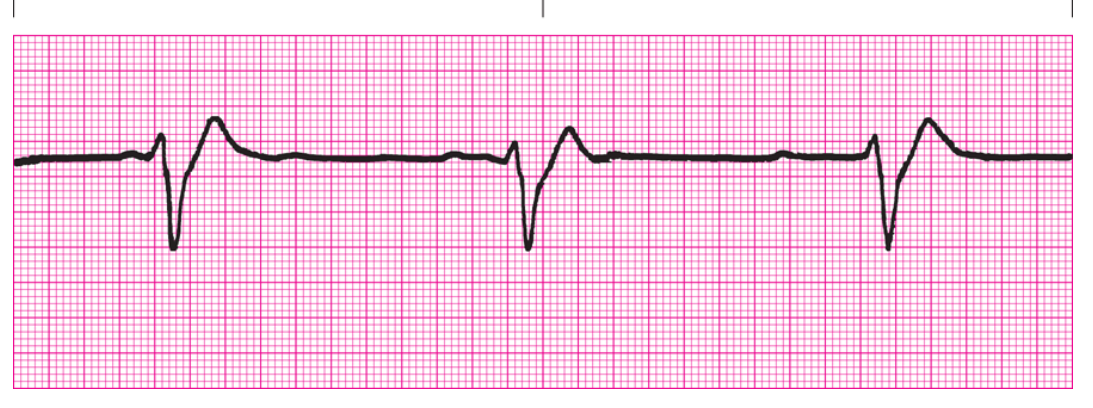 <ol><li><p>Regularity?</p></li><li><p>Rate</p></li><li><p>P Waves</p></li><li><p>PRI</p></li><li><p>QRS</p></li><li><p>Interpretation</p></li></ol><p></p>