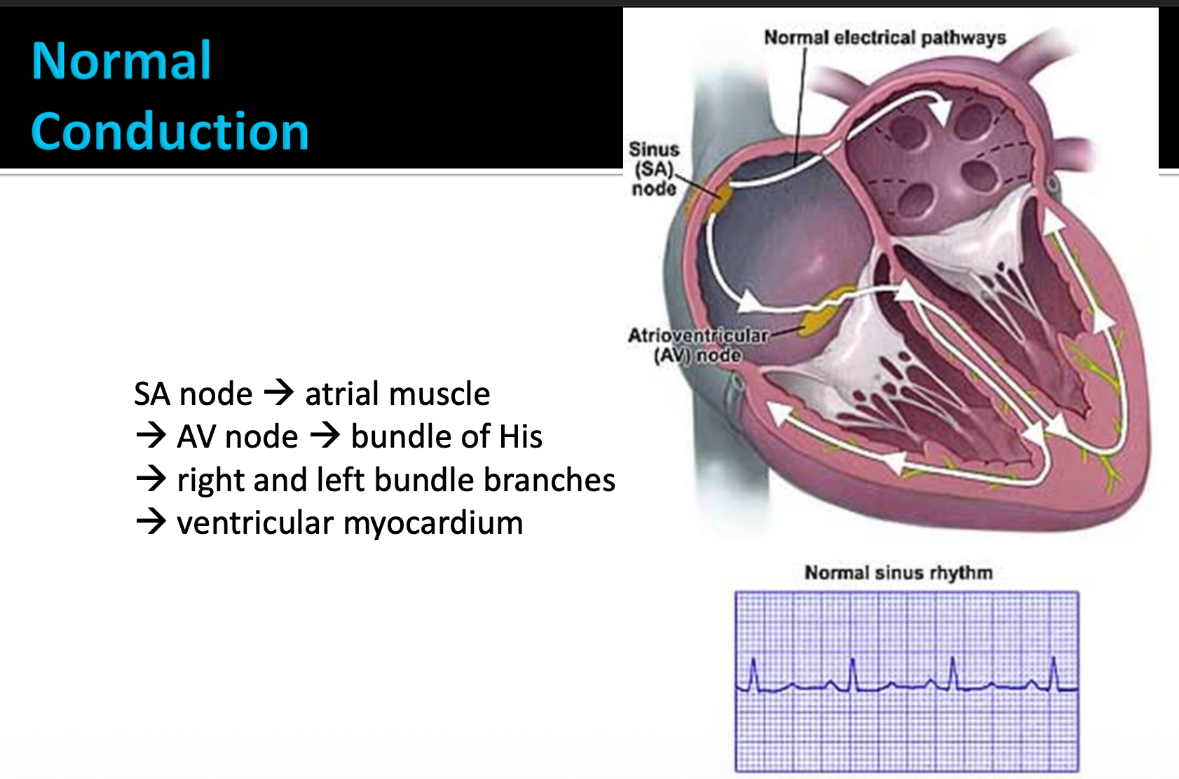 <p><span style="color: red;">Normal conduction vs AFib conduction</span></p>