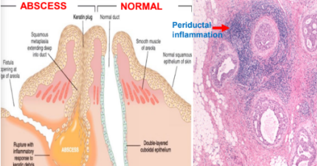 <p>PERIDUCTAL INFLAMMATION: </p><p></p>