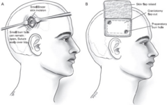 <p>- burr holes is less invasive </p><p>- often considerations are the surgical lesion, patient age/comorbidities, chronicity and size of SDH</p>