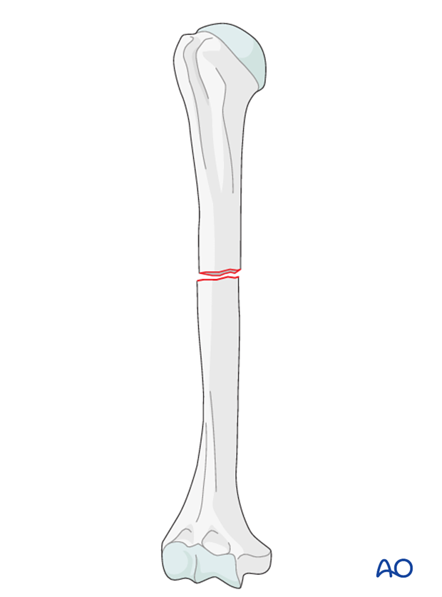 <p>What is a closed (simple) fracture?</p>