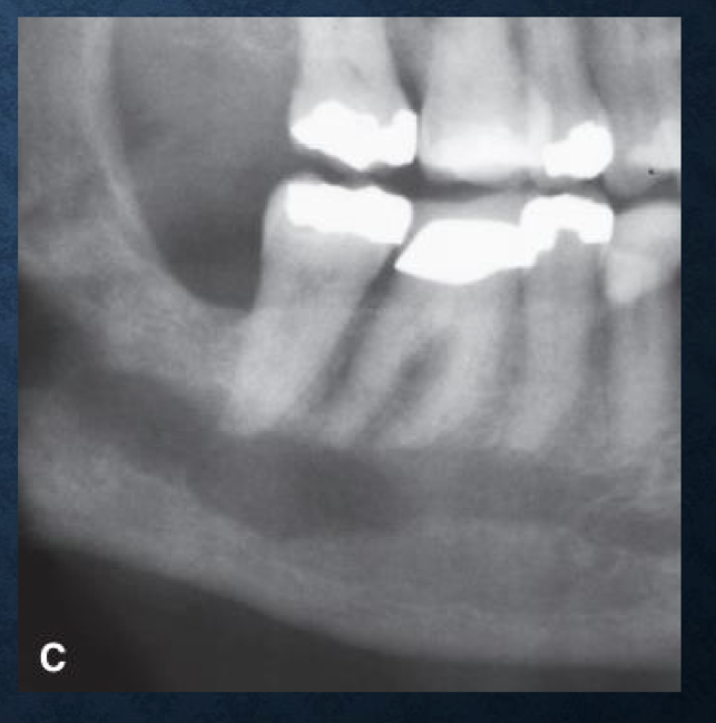 <p>irregular widening of the IAN with cortical destruction is typically associated with…</p>
