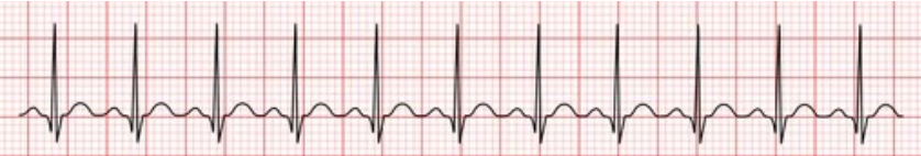 <p>Identify the rhythm shown on the EKG.</p>
