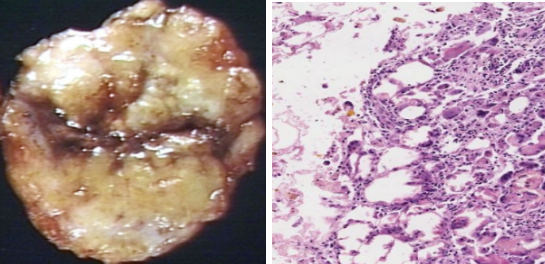 <p>What pathology? What stage (Acute/ Subacute)?</p>