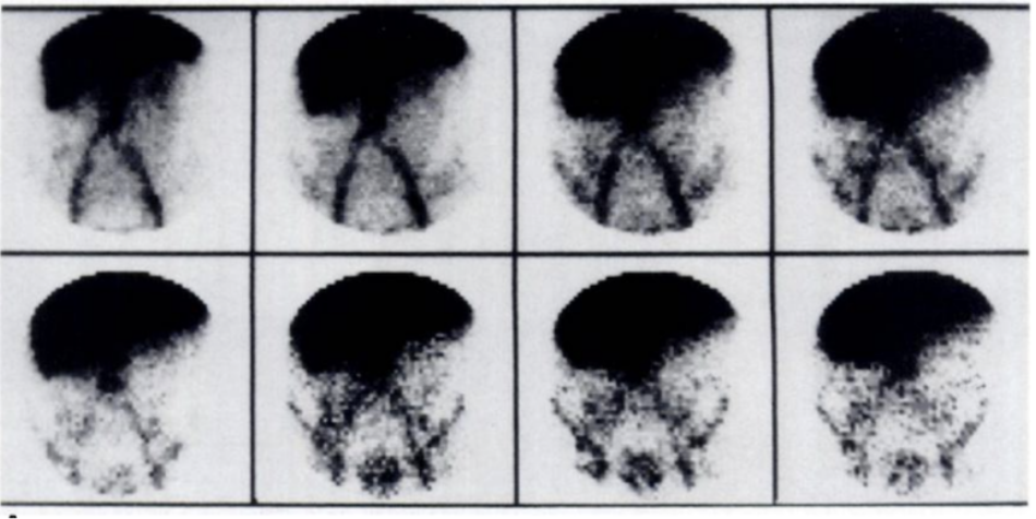 <ul><li><p>active bleeding OR bleeding most likely seen after 5min of imaging</p></li><li><p>appears focal area of inc. activity then becomes more intense ad background decreases </p></li><li><p><strong>IF YOU HAVE TO RESCAN YOU HAVE TO RE-INJECT </strong></p></li><li><p><strong>Higher bleeds can be missed </strong></p></li></ul><p></p>