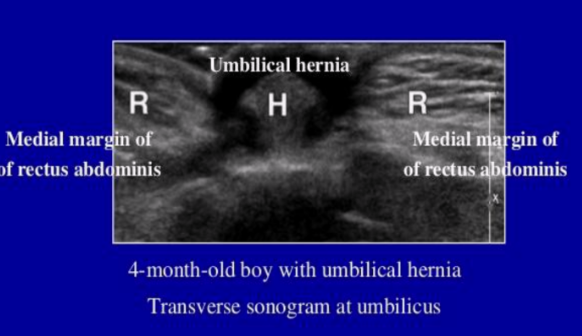 <ul><li><p>Most common ventral hernia</p></li><li><p>Common in women and children</p></li></ul><p></p>