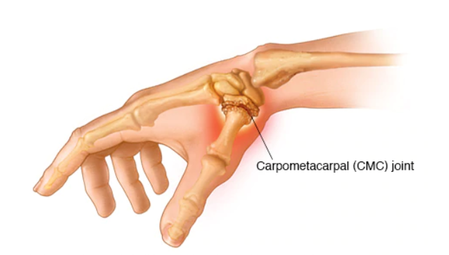 <p>Bones involved in carpometacarpal #1 joint</p>