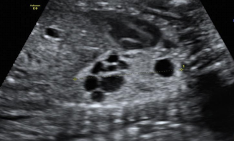 <p>mainly solid with multiple small cysts < 2cm</p><ul><li><p>hyperechoic mass with detectable cysts </p></li></ul><p></p>