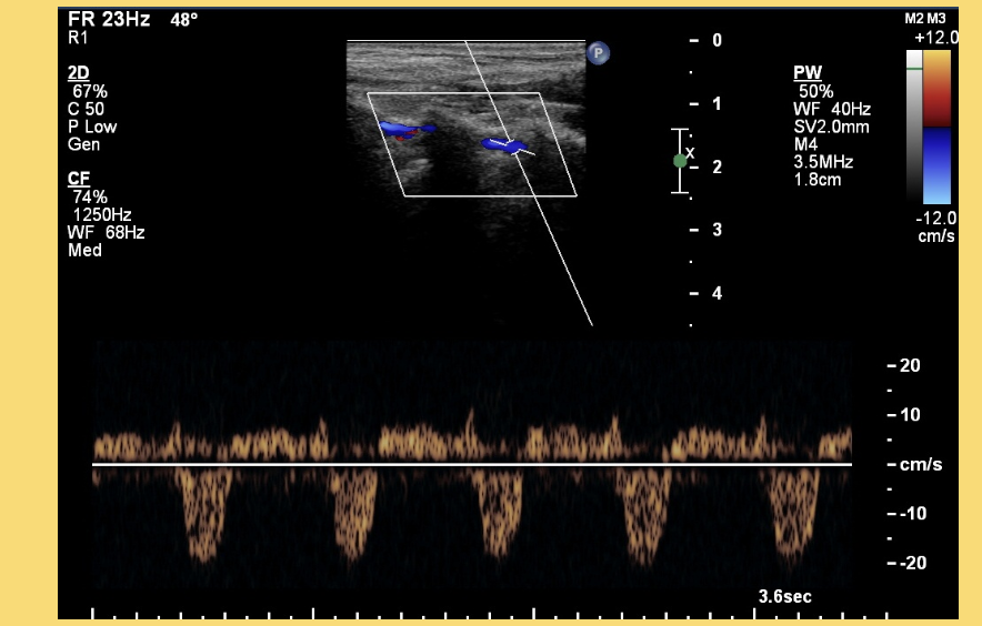<p>Know the difference between normal vertebral artery vs retrograde vertebral artery</p>