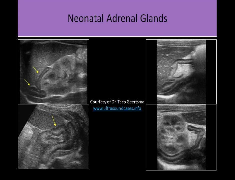 <p>C. as a hypochoic ring around the echogenic medulla</p>