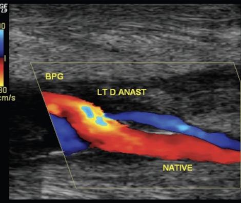 <p>slight <em>increase </em>in PSV</p>