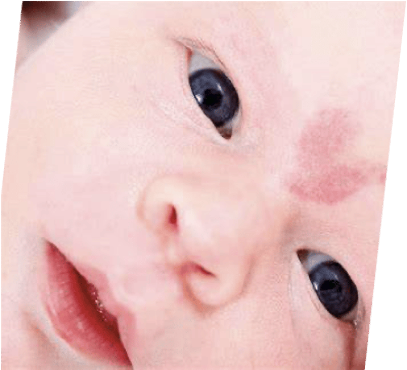 <p>pink-red macule on upper eyelids, upper eyelid, forehead or nape of neck</p>