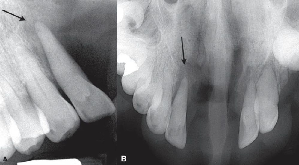 <p>area of few or no trabeculae</p><p>focus on marrow spaces creating finger like projections</p><p>rapid growth, malignancy</p>