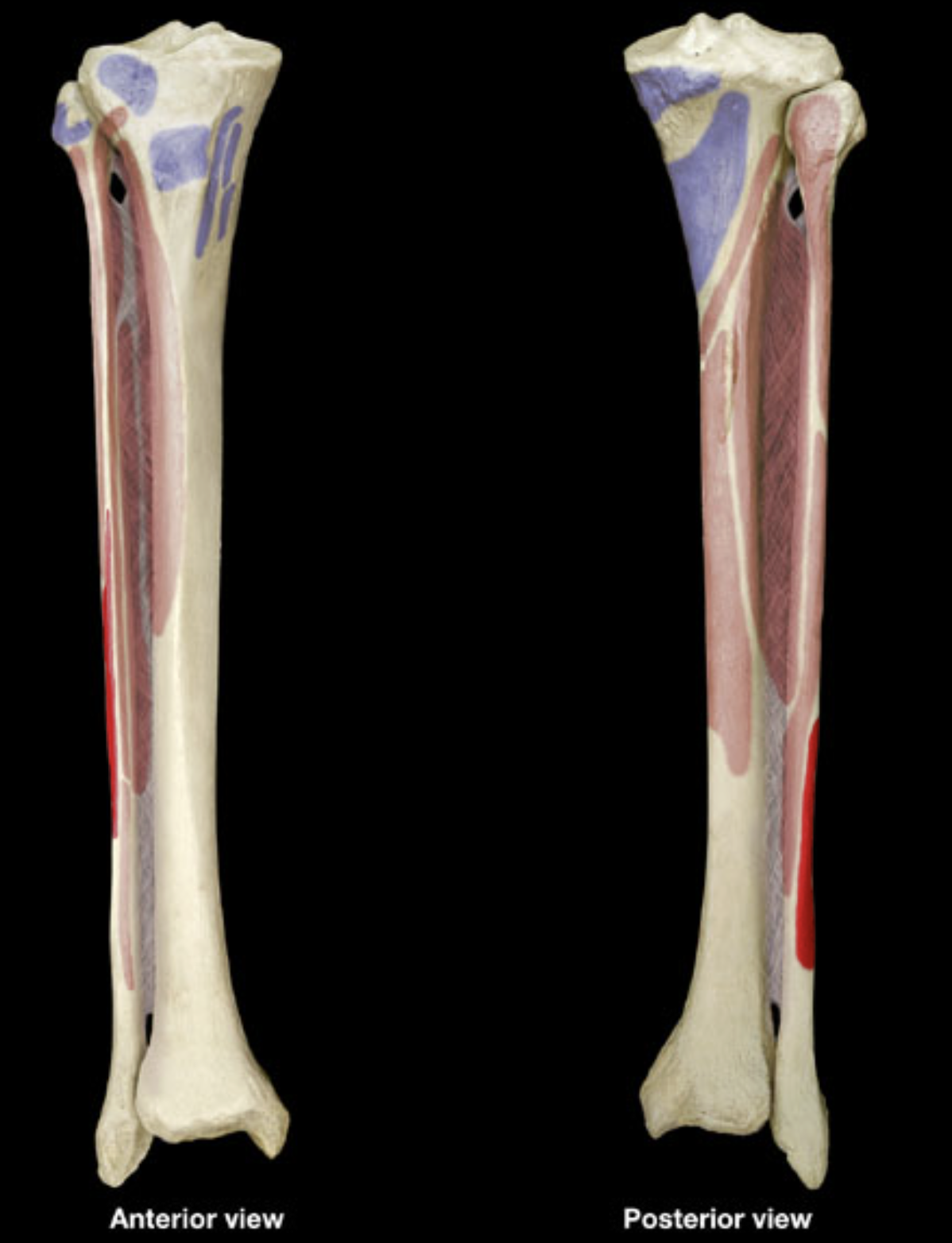 <p>distal shaft of fibula</p>