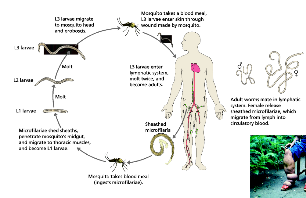 <p>A roundworm, vector borne parasite causing elephantiasis. The lymphatic drainage is blocked causing chronic pathology and is high risk for localized secondary infections. High IgE presence. </p>