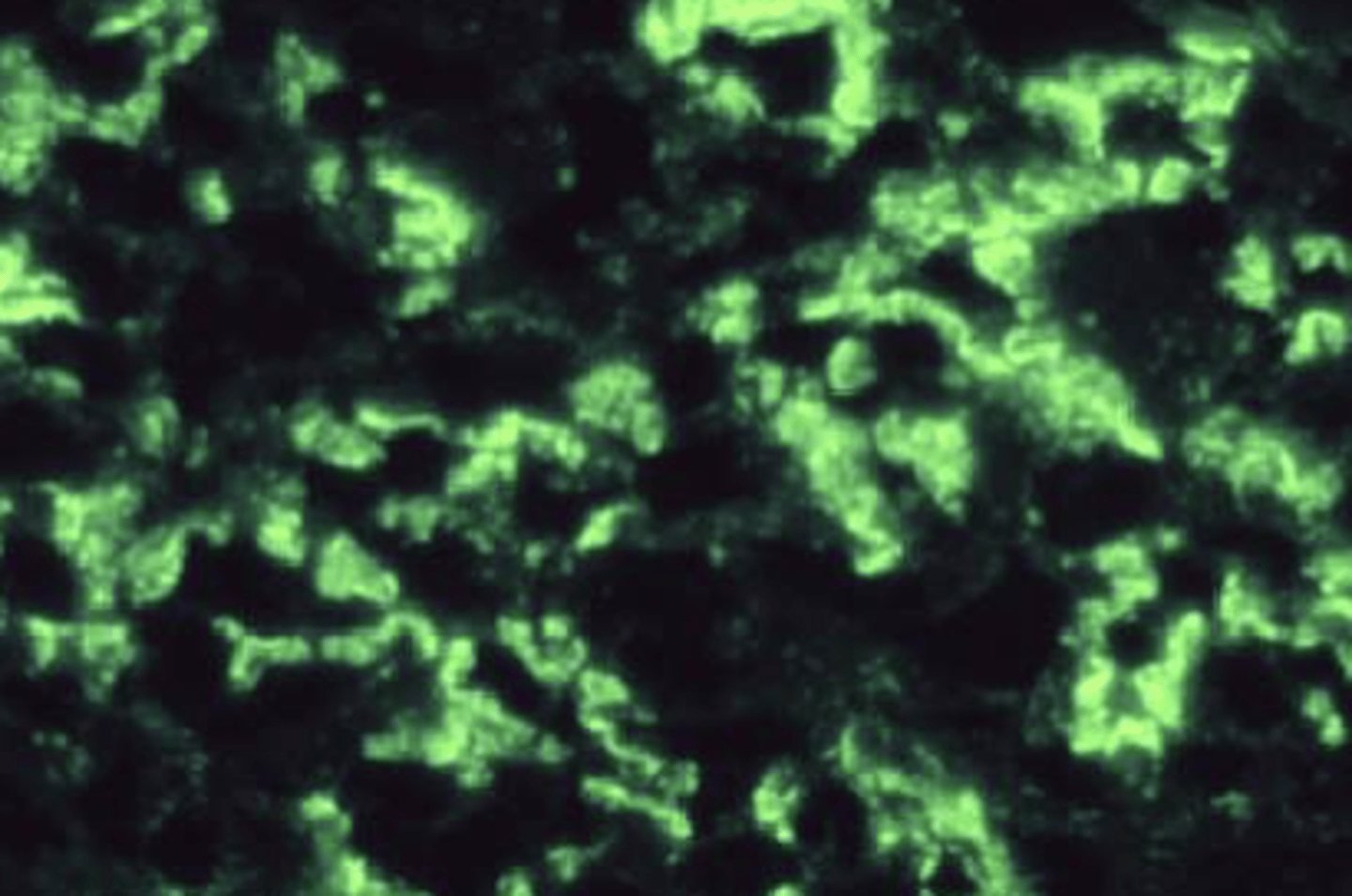<p>Gross hematuria +/- protein</p>