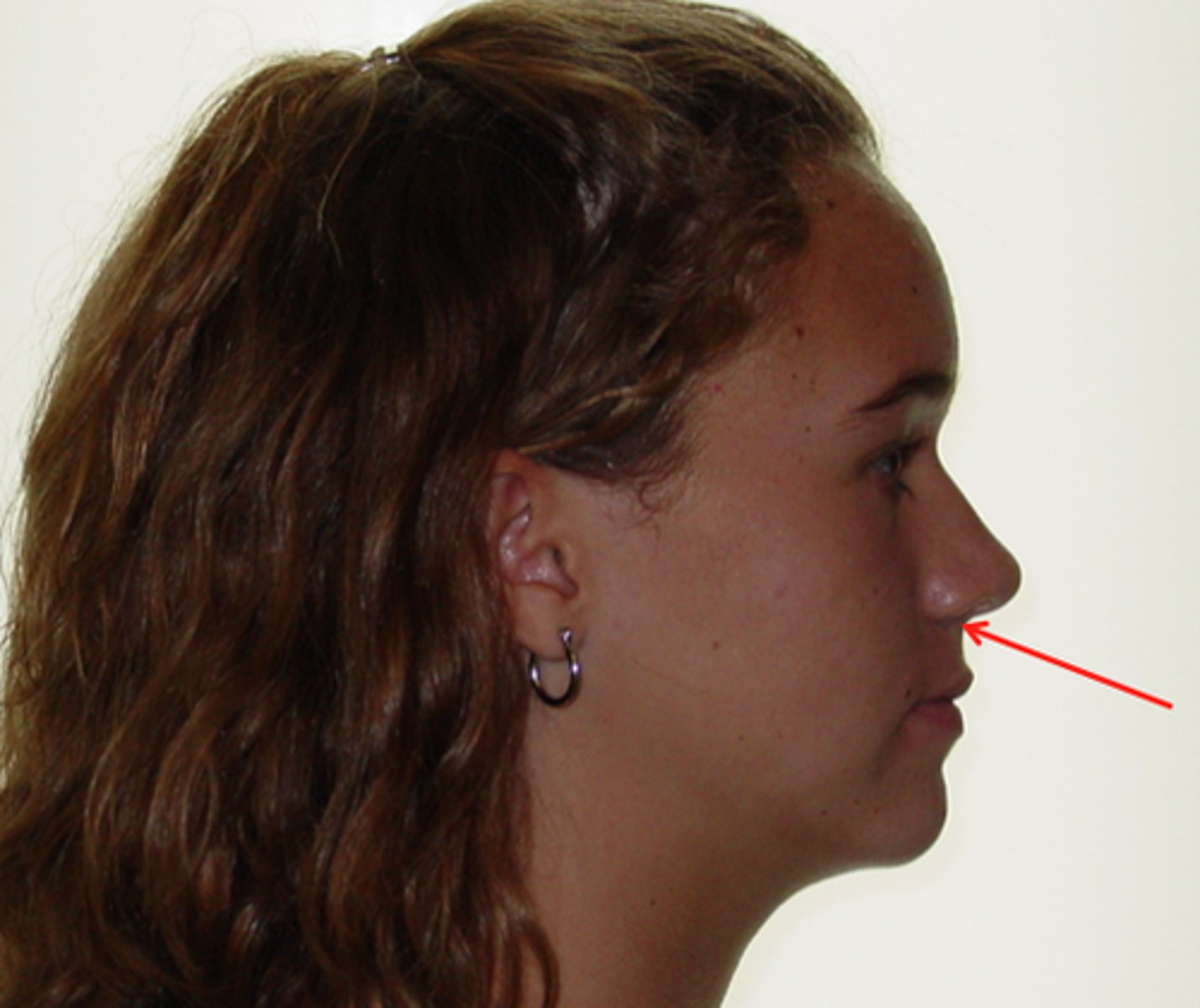 <p>Define the following:</p><p>The point at which the nasal septum merges with the upper lip in the midsagittal plane</p>