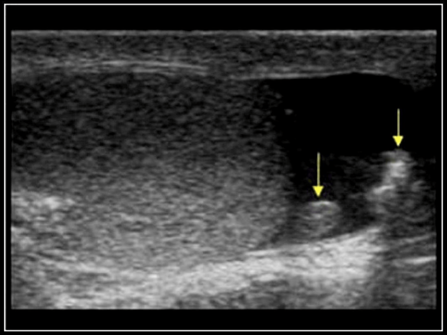 <p>the arrows indicate a remnant of the Mullerian duct and a scrotal calcification</p>