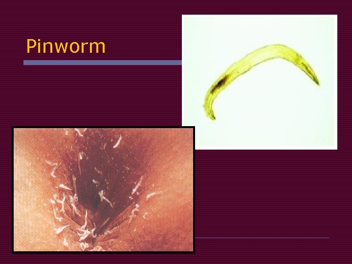 <p><span style="color: rgb(146, 18, 18);">→ spreads through</span></p><ul><li><p><span style="color: rgb(146, 18, 18);">1) <strong>contaminated hands</strong> (</span><span style="color: rgb(5, 3, 3);">scratching butt then touching mouth)</span></p></li></ul><ul><li><p><span style="color: rgb(146, 18, 18);">2)<strong> Dirty toys/ surfaces</strong></span></p></li><li><p><span style="color: rgb(146, 18, 18);">3)<strong> Close contact</strong> </span>with infected children</p></li></ul><p><span style="color: rgb(205, 54, 201);">→ s/s:</span></p><ol><li><p><span style="color: rgb(205, 54, 201);"><strong>itchy butthole</strong></span></p></li><li><p><span style="color: rgb(205, 54, 201);"><strong>restless sleep</strong></span></p></li></ol><p></p><p><span style="color: rgb(68, 168, 48);">→ dx:</span></p><ol><li><p><span style="color: rgb(68, 168, 48);"><strong>tape test</strong></span></p></li></ol><ul><li><p><span style="color: rgb(68, 168, 48);">Clear tape pressed against the <strong>butthole in the morning before bathing</strong></span></p><ul><li><p>worm eggs stick to tape</p></li></ul></li></ul><p></p><p></p>
