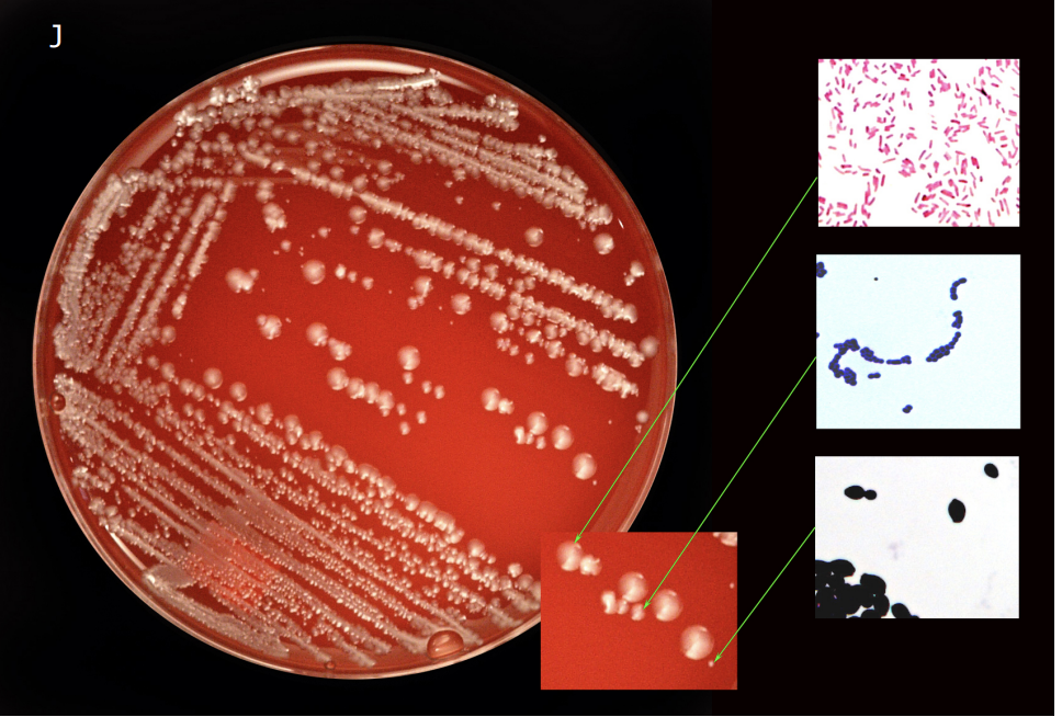 <p>PLATE J: </p><p>Candida albicans </p><p>E. coli </p><p>Ent. faecalis </p><p>There are three colonies present. One large cream colony, a Gram-negative bacillus, which could be either E.coli or Salmonella (considering the source, likely to be E.coli). A medium colony with watery edges, a Gram-positive coccus, that may show chain formation suggesting Ent faecalis. The small colony is small and chalky white and when the organisms are Gram stained appear as large ovoid Gram-positive yeast, which may show some evidence of budding, so is probably Candida albicans.</p>