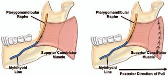 <p>-lower 1/3 of the posterior border of the medial pterygoid plate and its hamulus</p><p>-pterygomandibular raphe</p><p>-mylohyoid line of the mandible</p><p>-side of the root of the tongue</p>