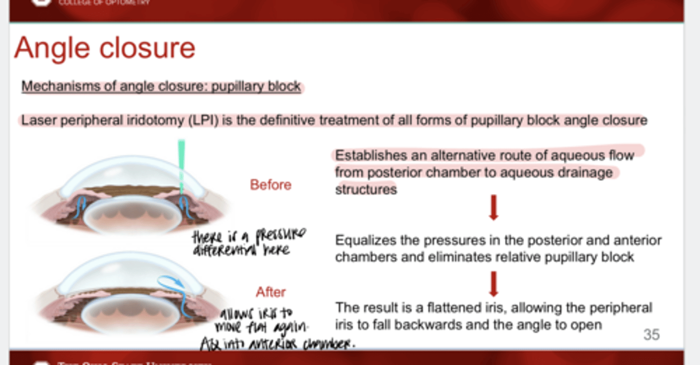 <p>What is the definitive treatment for all forms of pupillary block angle closure?</p>