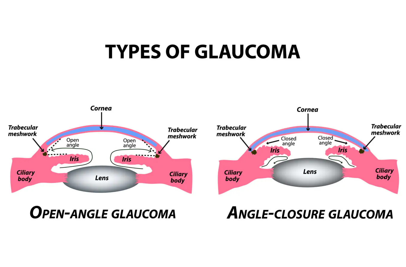 <p>PP/E: iris blocks exit of aqueous humor from anterior chamber→increased intraocular pressure→optic nerve cell death</p><p>RF: larger cup→higher risk</p><p>CM: <strong>intense ocular pain</strong><br>blurred vision<br>halos around lights<br>nausea<br>vomiting</p><p>DX: diffuse conjunctival injection<br>dilated+fixed pupil<br>clouding of cornea</p>