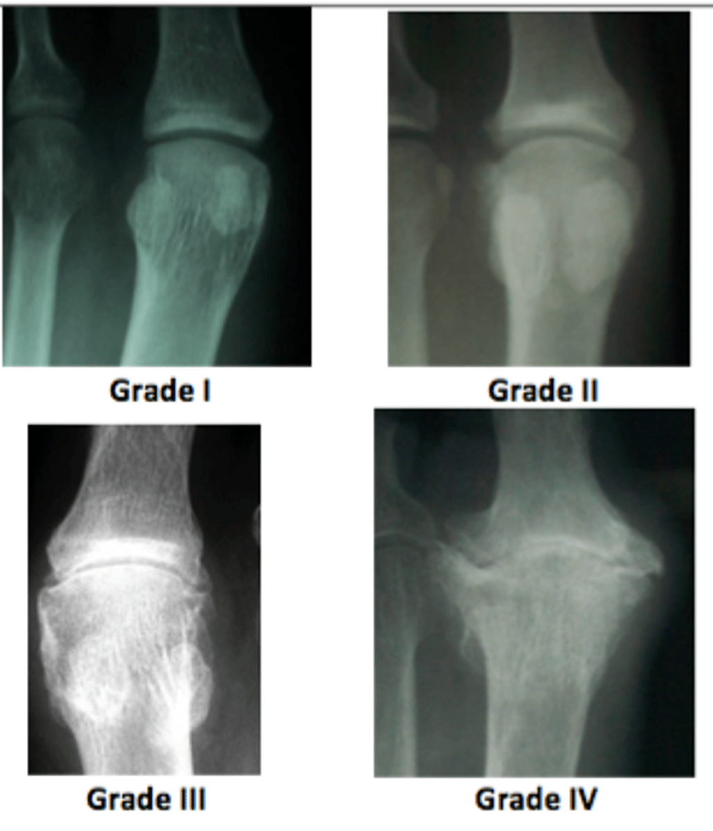 <p>Classification for Osteoarthritis</p><p>Grade I: Doubtful narrowing of joint space with possible osteophytic lipping.</p><p>Grade II: Definite osteophytes with possible narrowing of joint space.</p><p>Grade III: Multiple osteophytes, definite jt. space narrowing, sclerosis, possible deformity of bone contour.</p><p>Grade IV: Large osteophytes, significant jt space narrowing, severe sclerosis, definite deformity of bone contour.</p>