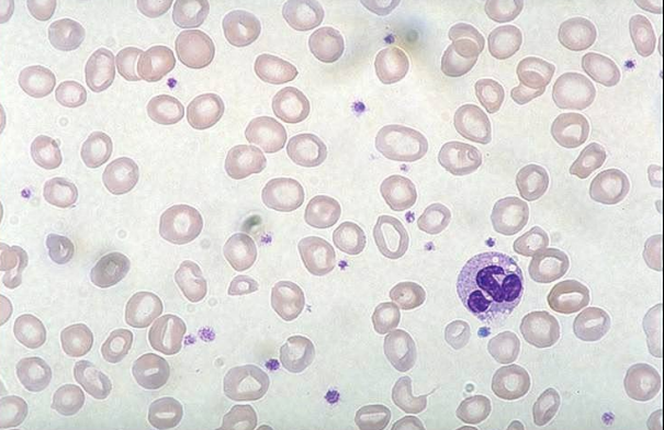 <p>what anemia is this?</p>