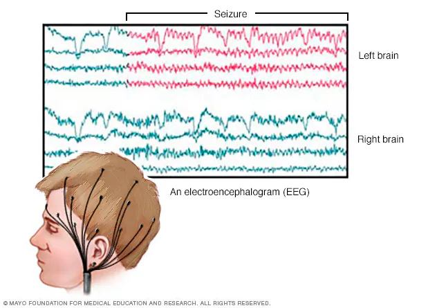 <p>amplified recording of electrical waves sweeping across the brain’s surface (result just looks like brain waves) </p>
