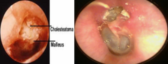 <p>Cholesteatoma</p>