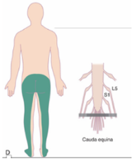 <p><span style="background-color: transparent;"><span>-Damage to the lumbar and/or sacral spinal roots (Below L2)</span></span></p><p><span style="background-color: transparent;"><span>-Saddle anesthesia</span></span></p><p><span style="background-color: transparent;"><span>-Flaccid lower limb paralysis</span></span></p><p><span style="background-color: transparent;"><span>-Flaccid bowel/bladder sphincters</span></span></p><p><span style="background-color: transparent;"><span>-Lack of penile erection</span></span></p><p><span style="background-color: transparent;"><span>-LMN injury</span></span></p><p><span style="background-color: transparent;"><span>-Asymmetric weakness</span></span></p><p><br></p>