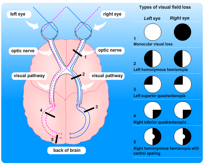 <p>partial damage to optic radiation→”pie in the sky” vision loss</p>