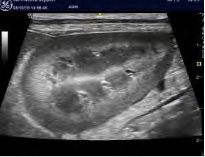 <p>what is seen in the following ultrasound?</p>